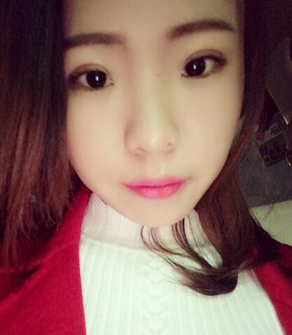 割雙眼皮術(shù)后恢復(fù)過程 全切雙眼皮3個月