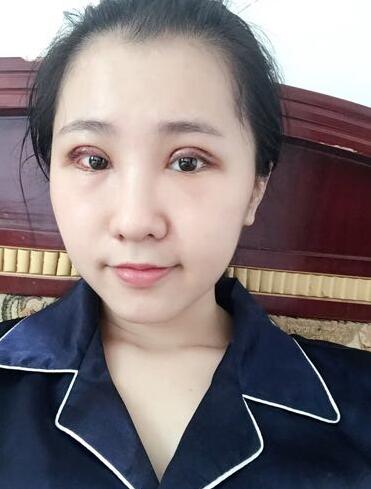 切的雙眼皮90天恢復(fù)過(guò)程圖
