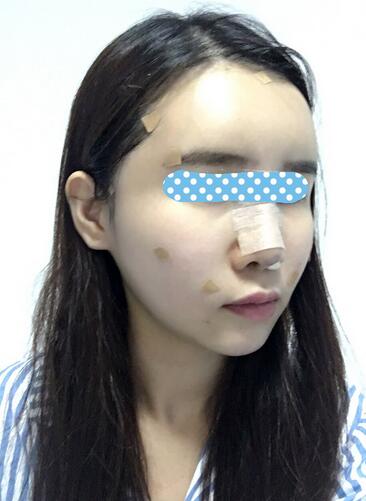 自體脂肪填充后2個(gè)月圖