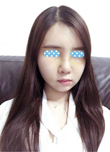 自體脂肪填充后2個(gè)月圖