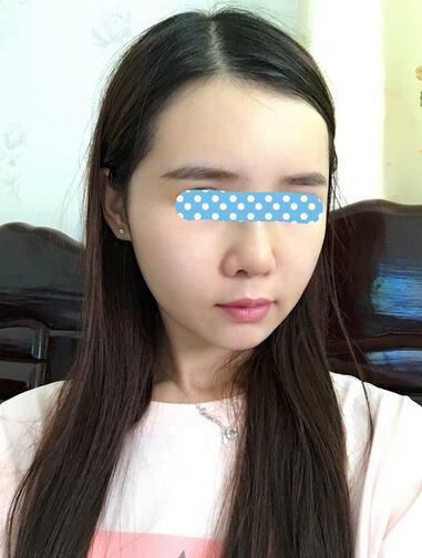 自體脂肪填充后2個(gè)月圖