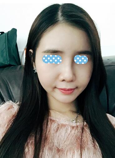 自體脂肪填充后2個(gè)月圖