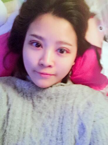 雙眼皮+開(kāi)眼角3個(gè)月恢復(fù)過(guò)程圖