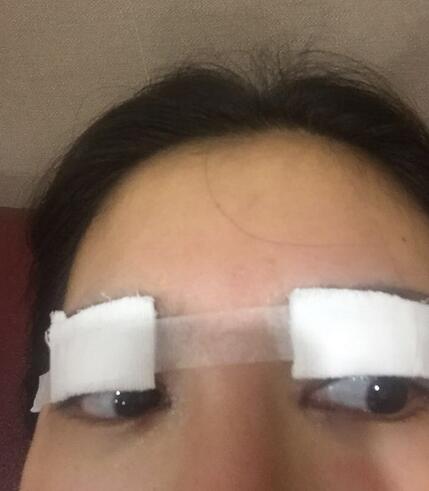 雙眼皮+開(kāi)眼角3個(gè)月恢復(fù)過(guò)程圖