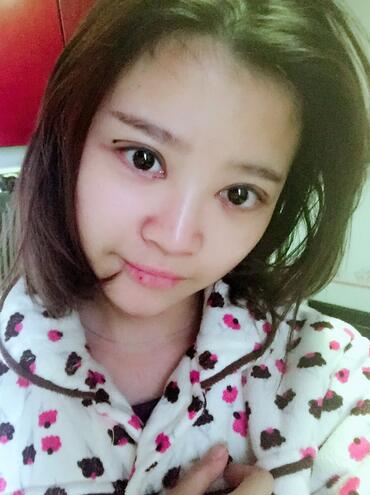 雙眼皮+開(kāi)眼角3個(gè)月恢復(fù)過(guò)程圖