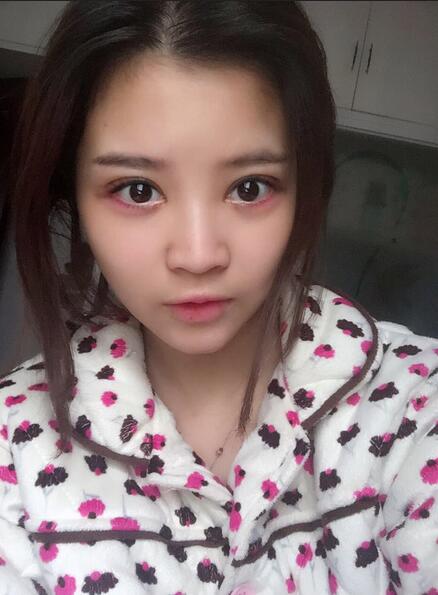 雙眼皮+開(kāi)眼角3個(gè)月恢復(fù)過(guò)程圖