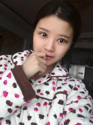 雙眼皮+開(kāi)眼角3個(gè)月恢復(fù)過(guò)程圖