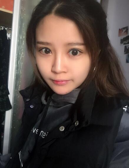 雙眼皮+開(kāi)眼角3個(gè)月恢復(fù)過(guò)程圖