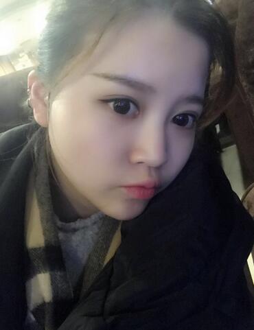 雙眼皮+開(kāi)眼角3個(gè)月恢復(fù)過(guò)程圖