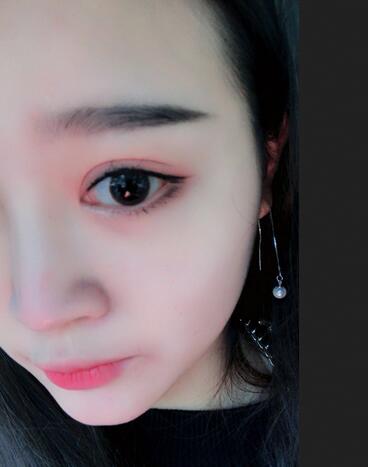 雙眼皮+開(kāi)眼角3個(gè)月恢復(fù)過(guò)程圖