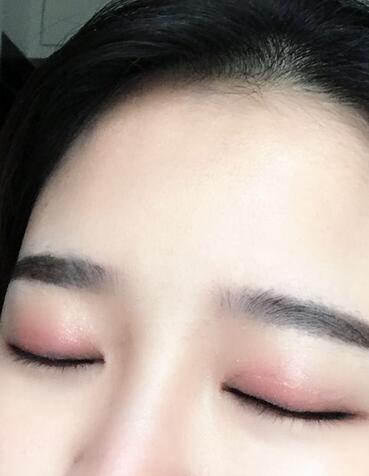 雙眼皮+開(kāi)眼角3個(gè)月恢復(fù)過(guò)程圖