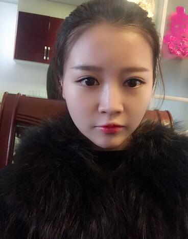 雙眼皮+開(kāi)眼角3個(gè)月恢復(fù)過(guò)程圖