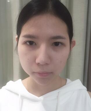 自體脂肪填充恢復(fù)日志 自體脂肪填充太陽穴+額頭