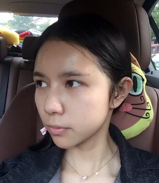 自體脂肪填充恢復(fù)日志 自體脂肪填充太陽穴+額頭