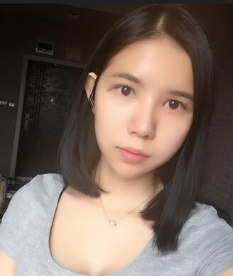 自體脂肪填充恢復(fù)日志 自體脂肪填充太陽穴+額頭