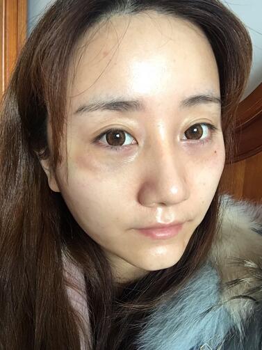 上海潔銘線D提升三個(gè)月后的圖片