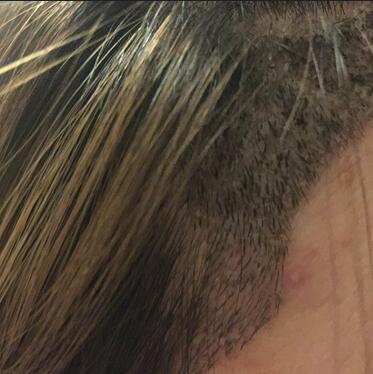 廣州倍生女性發(fā)際線調(diào)整案例