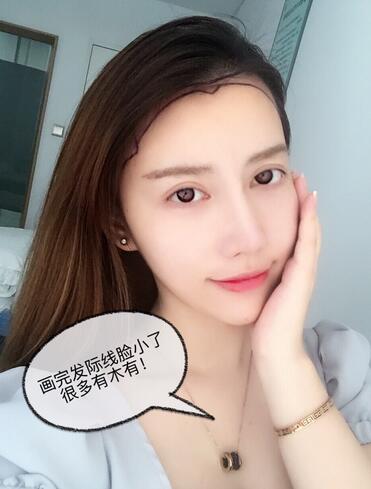 廣州倍生發(fā)際線種植前后對比照片