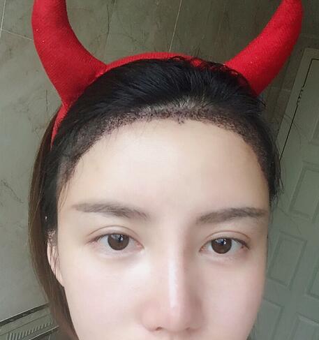 廣州倍生發(fā)際線種植前后對比照片