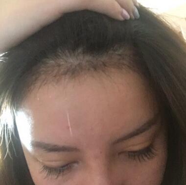 廣州倍生發(fā)際線種植前后對比照片