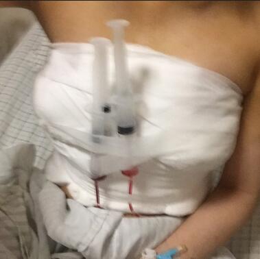 武漢詮美曼托假體隆胸半年啦~