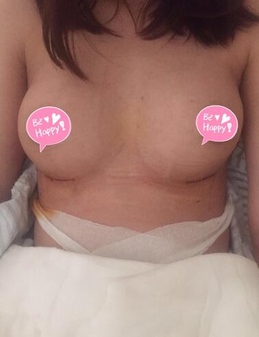 武漢詮美曼托假體隆胸半年啦~