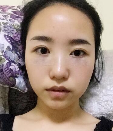 武漢憶美凱德去眼袋手術(shù)后兩個(gè)月照片