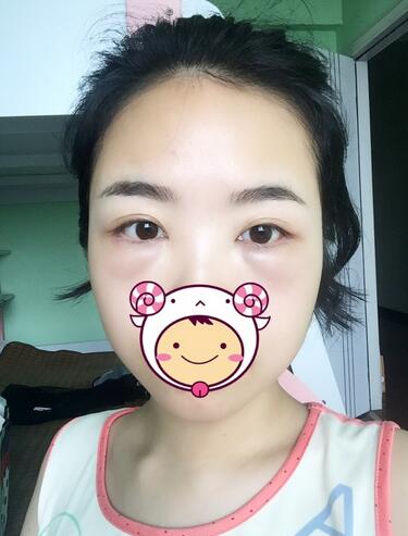 武漢憶美凱德去眼袋手術(shù)后兩個(gè)月照片