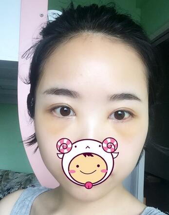 武漢憶美凱德去眼袋手術(shù)后兩個(gè)月照片