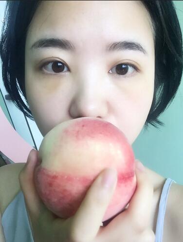 武漢憶美凱德去眼袋手術(shù)后兩個(gè)月照片