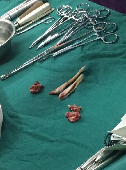 北京八大處張智勇V-line瓜子臉手術(shù)前后對(duì)比