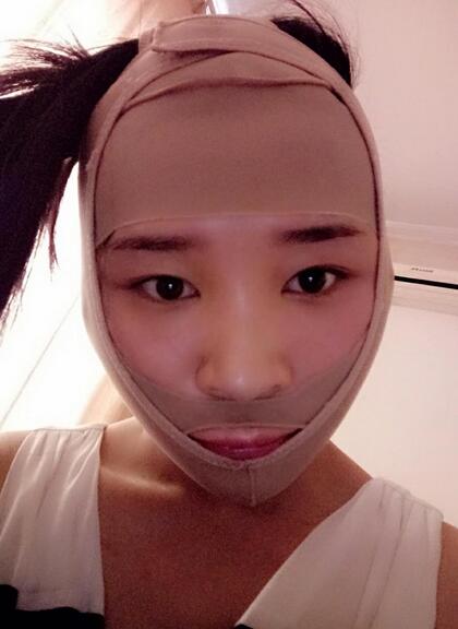 北京八大處張智勇V-line瓜子臉手術(shù)前后對(duì)比