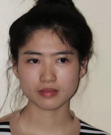 北京八大處下頜角截骨前后果對比