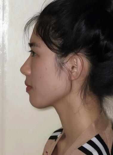 北京八大處下頜角截骨前后果對比