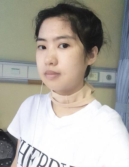 北京八大處下頜角截骨前后果對比