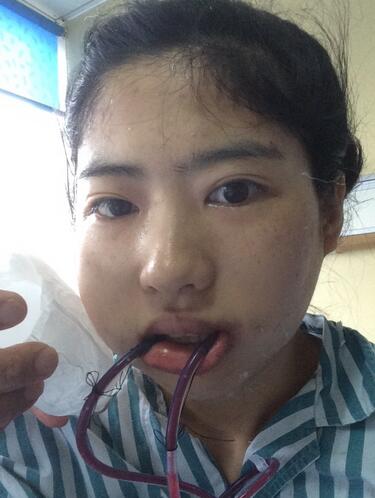 北京八大處下頜角截骨前后果對比