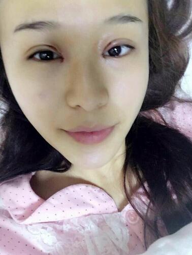 杭州大麥微針龍都整形開眼角+割雙眼皮恢復記錄