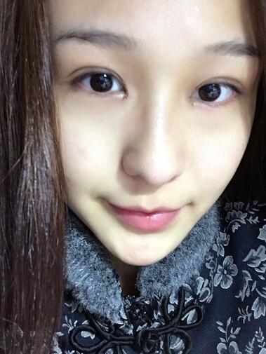 杭州大麥微針龍都整形開眼角+割雙眼皮恢復記錄