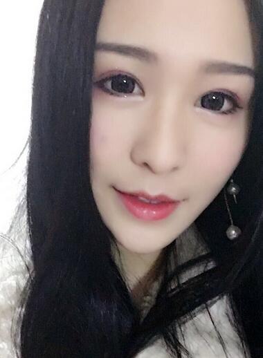 杭州大麥微針龍都整形開眼角+割雙眼皮恢復記錄