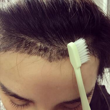 發(fā)際線調(diào)整果對(duì)比圖 杭州大麥微針龍都發(fā)際線種植