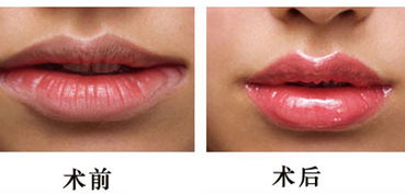 成都做嘴唇整形需要多少錢