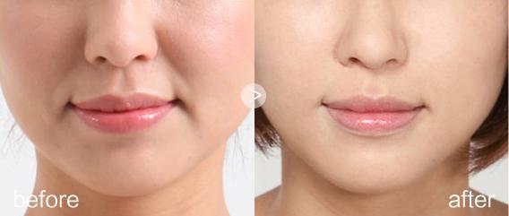 上海注射注射除皺價格是多少