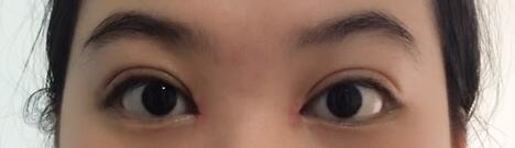 韓式微創(chuàng)雙眼皮恢復(fù)圖 深圳妍熙雙眼皮半年