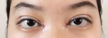 韓式微創(chuàng)雙眼皮恢復(fù)圖 深圳妍熙雙眼皮半年