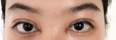韓式微創(chuàng)雙眼皮恢復(fù)圖 深圳妍熙雙眼皮半年