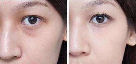 抬頭紋怎么去 去除抬頭紋要多少錢