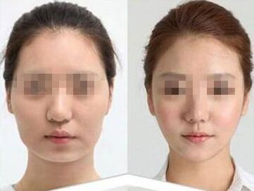 注射瘦臉B****價(jià)格 需要多少錢(qián)