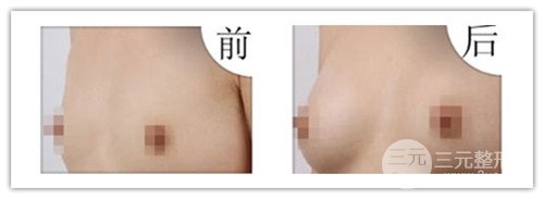 假體隆胸后可以運動嗎，可以鍛煉嗎