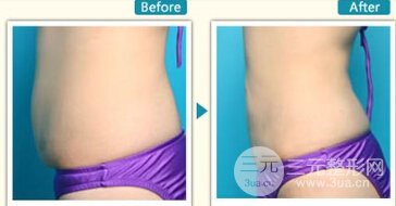 多大年齡可以做腰腹吸脂手術(shù)、果到底怎么樣