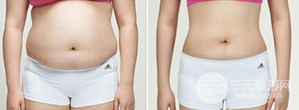 腰腹吸脂手術(shù)有哪些優(yōu)點(diǎn)、好處是什么